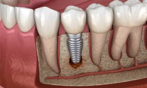 Hambaimplantaadi planeerimine
