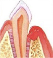 Kirurgiline parodontiidi ravi