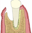 Kirurgiline parodontiidi ravi