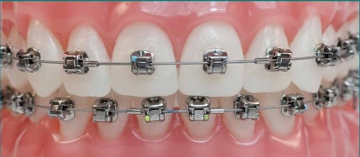 Damon Q braces