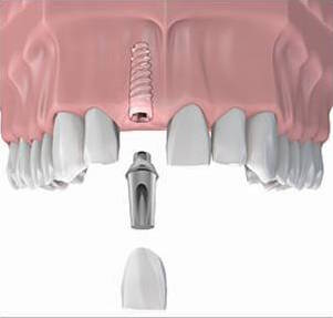 Hambaimplantaat - üksikute puuduvate hammaste asendamine