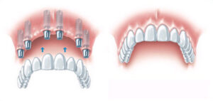 Hambaimplantaadid kogu ülemise või alumise lõualuu fikseeritud hambumuse taastamiseks