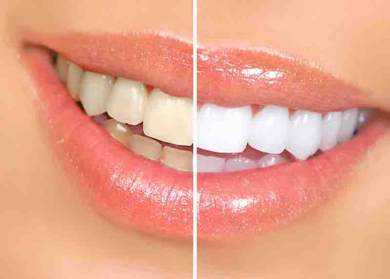 Белые зубы: как поддерживать белизну зубов?