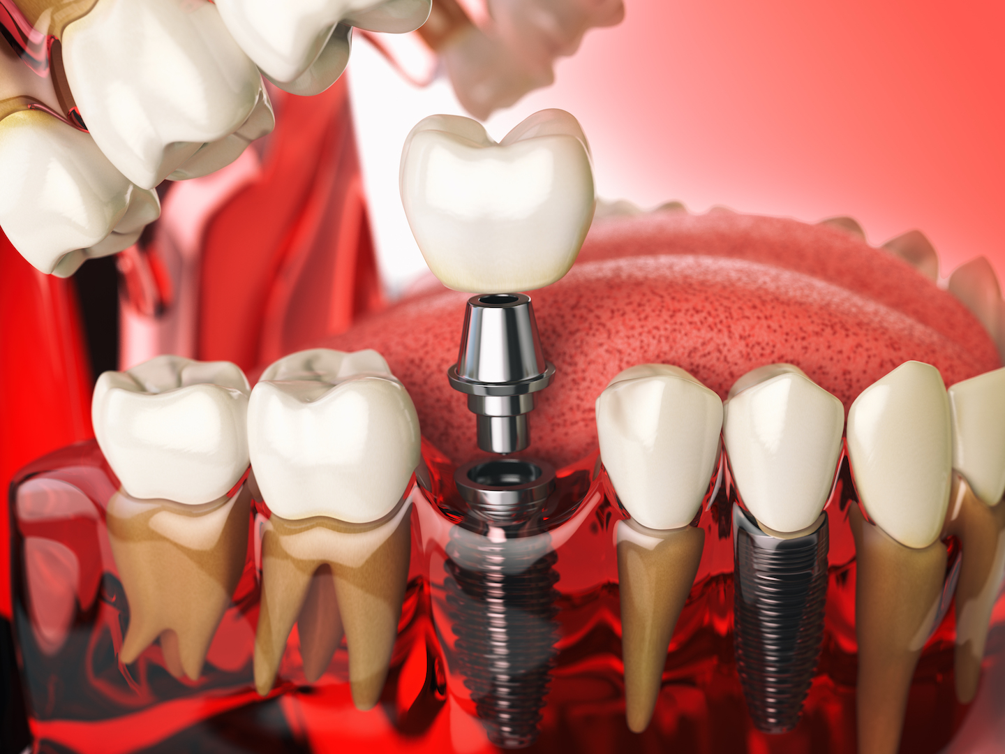 Hambaimplantaadid, selle eelised ja kasutusala